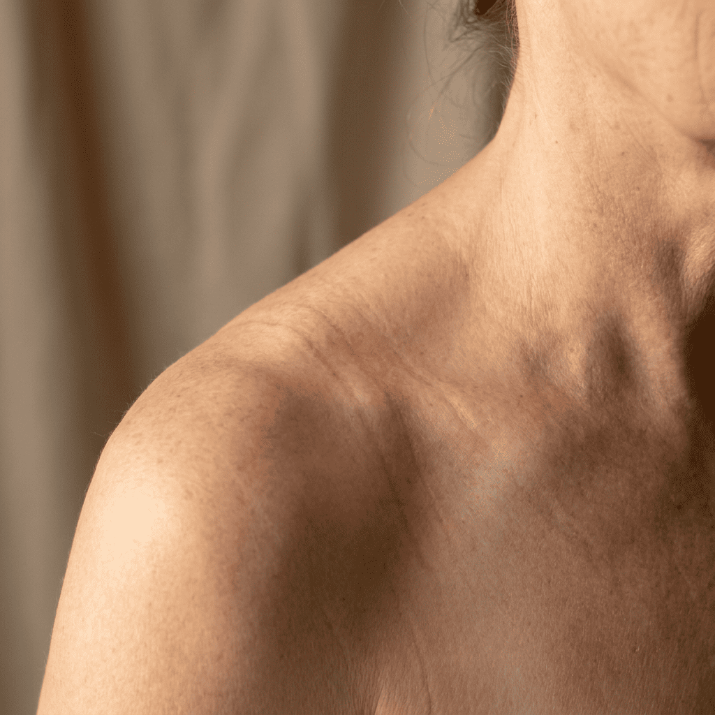 Gros plan sur des sillons rouges marqués sur les épaules d'une femme, à l'endroit où passent les bretelles